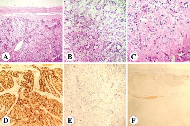 Aldosterone-Secreting Large Oncocytic Neoplasm of the Adrenal Gland with Borderline Potential.