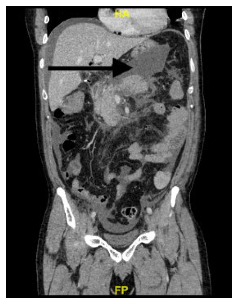 Acute Chest Pain in an Acute Complicated Pancreatitis with Severe Hypophosphatemia.