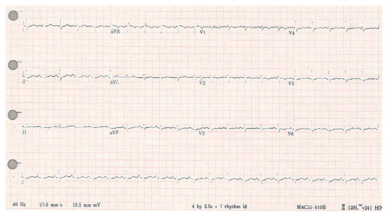 Acute Chest Pain in an Acute Complicated Pancreatitis with Severe Hypophosphatemia.