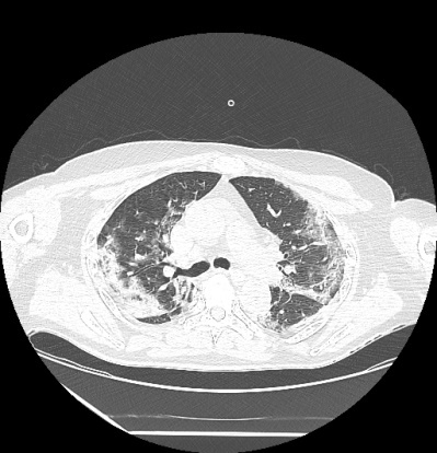 Positive Effects of Pulmonary Rehabilitation Among Patients with Obstructive Ventilatory Dysfunction Post COVID-19.