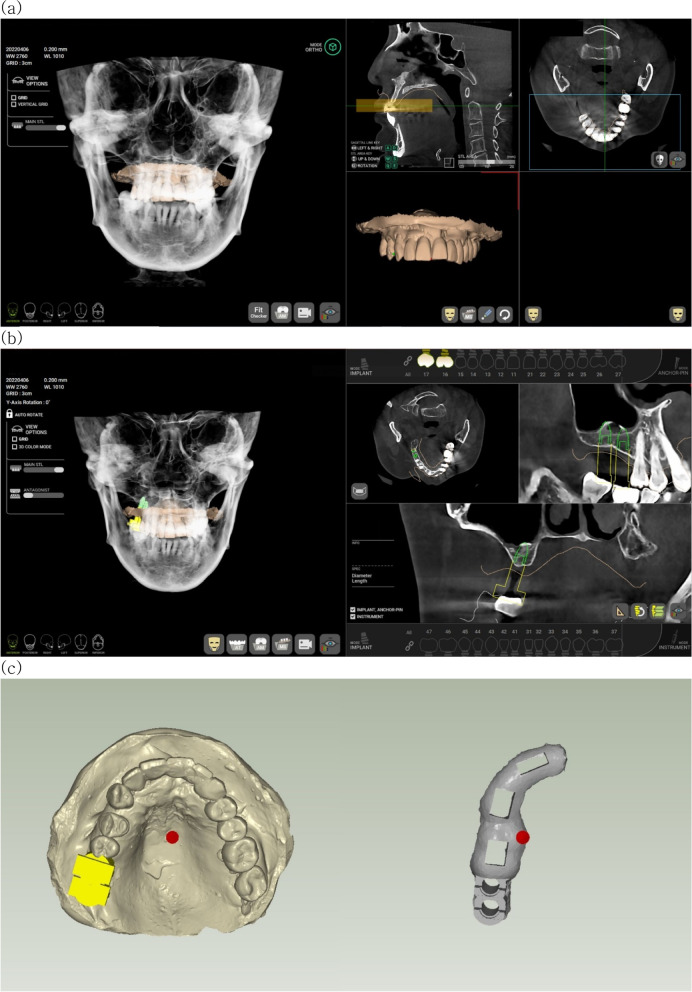 Accuracy of digital surgical guides for dental implants.