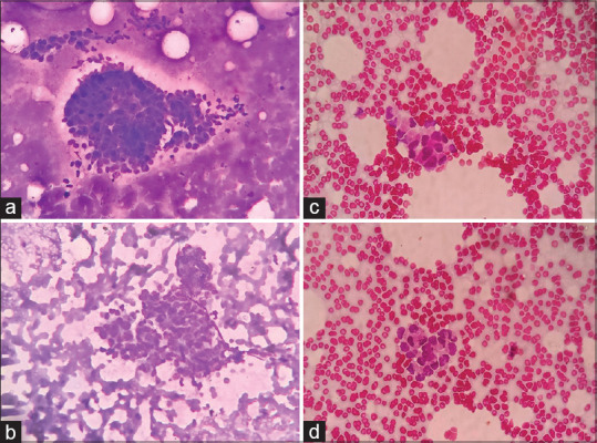 Reproducibility of the "International Academy of Cytology Yokohama System for Reporting Breast Cytology" - A Retrospective Analysis of 70 Cases.