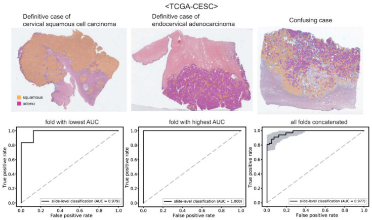 Deep Learning-Based Classification of Uterine Cervical and Endometrial Cancer Subtypes from Whole-Slide Histopathology Images.