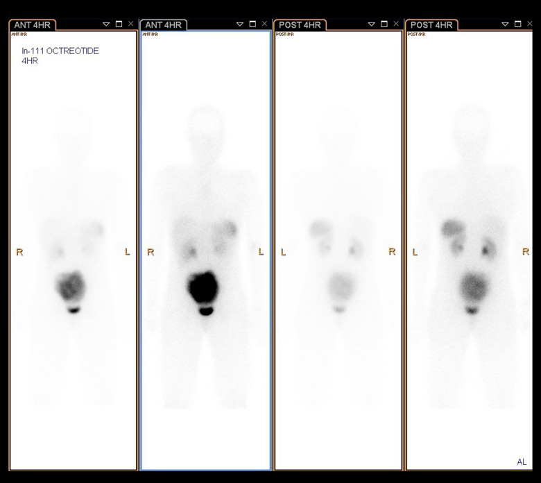 A Case of Primary Insular Ovarian Carcinoid Tumor with Hyperandrogenism and Carcinoid Heart Disease.