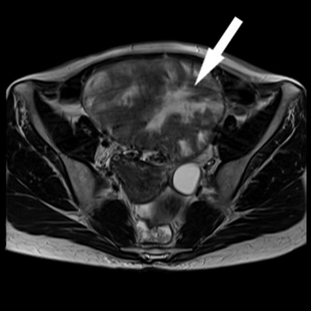 A Case of Primary Insular Ovarian Carcinoid Tumor with Hyperandrogenism and Carcinoid Heart Disease.