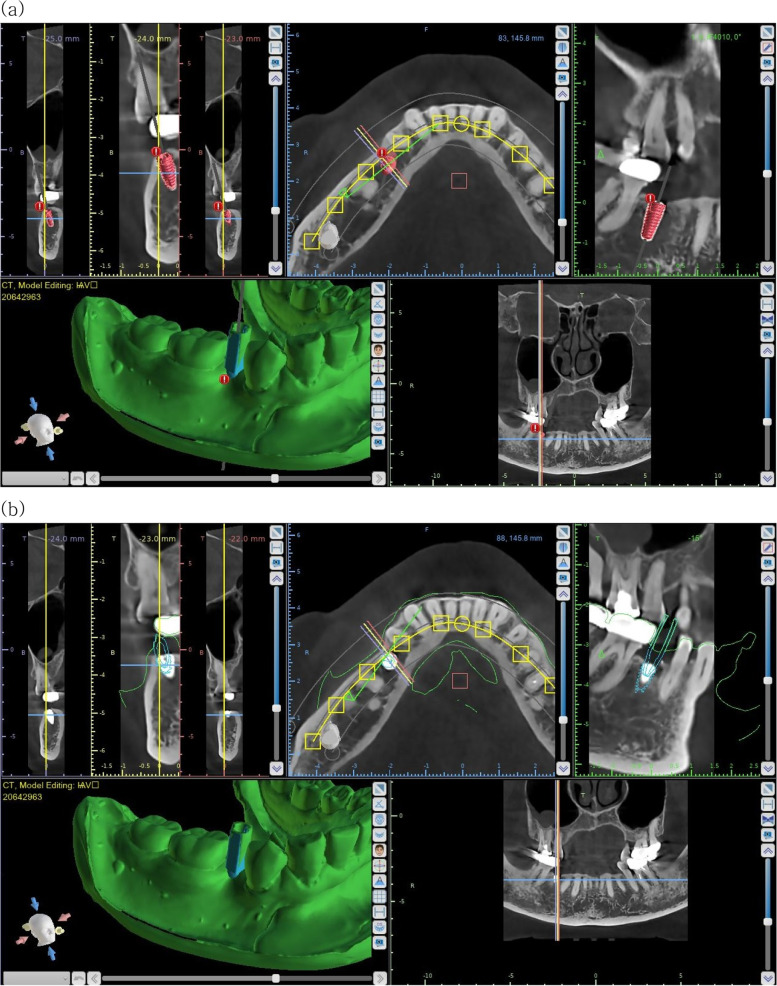 Accuracy of digital surgical guides for dental implants.