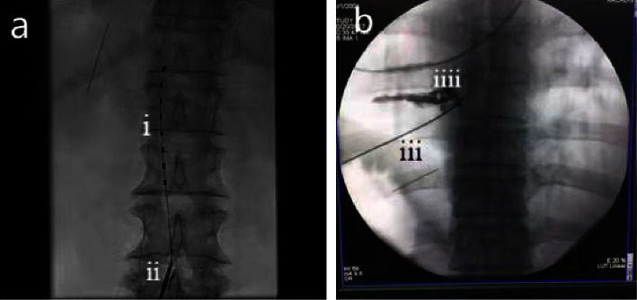 Comparison of the Efficacy and Safety of Temporary Spinal Cord Stimulation versus Pulsed Radiofrequency for Postherpetic Neuralgia: A Prospective Randomized Controlled Trial.