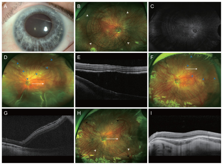 Rhegmatogenous Retinal Detachment in Waardenburg Syndrome: A Case Report.