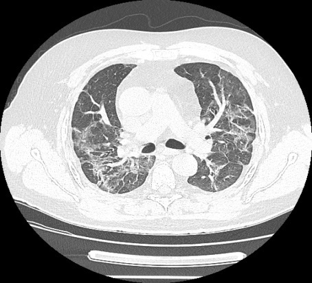 Positive Effects of Pulmonary Rehabilitation Among Patients with Obstructive Ventilatory Dysfunction Post COVID-19.