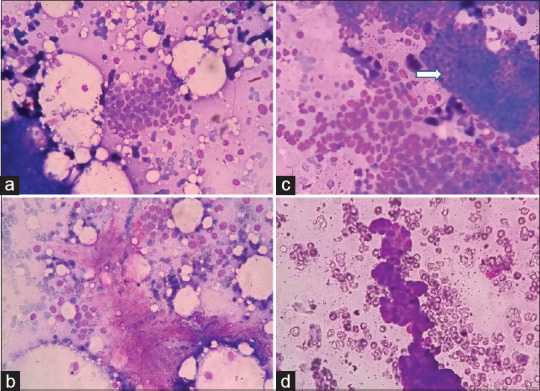 Reproducibility of the "International Academy of Cytology Yokohama System for Reporting Breast Cytology" - A Retrospective Analysis of 70 Cases.