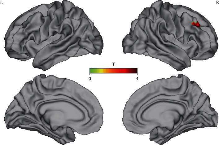 Self-Directed Neurofeedback Treatment for Subjective Tinnitus Patients Evaluated by Multimodal Functional Imaging.