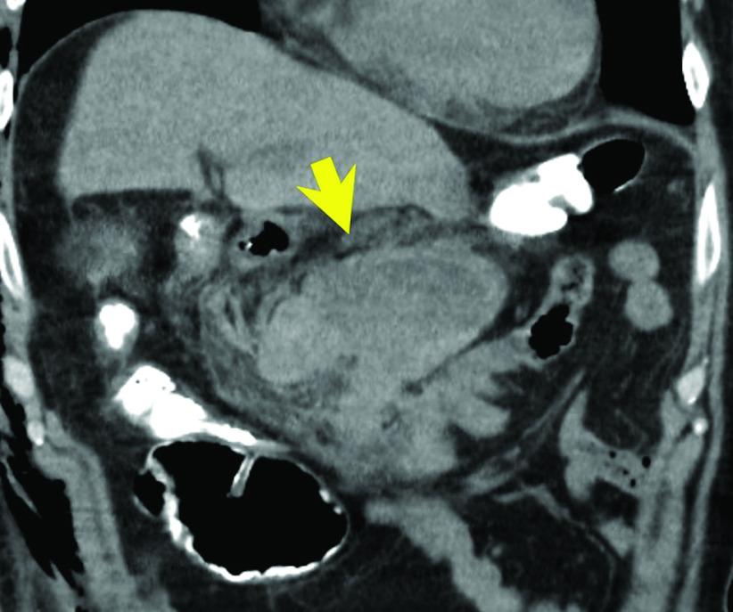 Esophageal Cancer Surgery in Dialyzed Patients: A Single Institution Case Series.