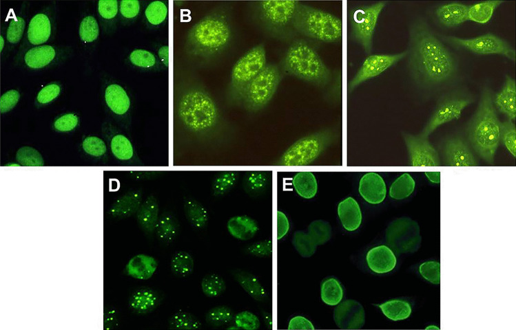 Autoimmune Hepatitis: Serum Autoantibodies in Clinical Practice.