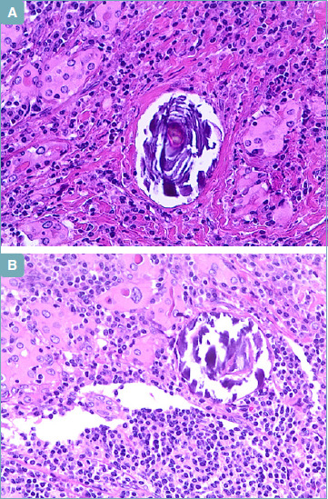 What psammoma bodies can represent in the thyroid. What we recently learnt from a story of lack of evidence.