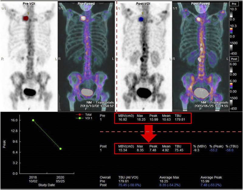 Quantitative bone SPECT/CT for evaluating treatment response in patient with sternoclavicular arthritis.