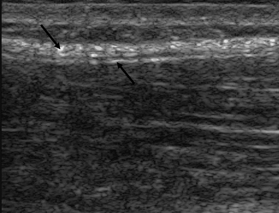 Thoracolumbar fascia mobility and chronic low back pain: Phase 2 of a pilot and feasibility study including multimodal chiropractic care.