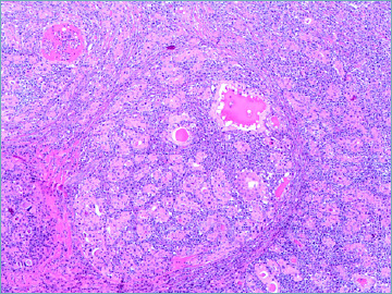 What psammoma bodies can represent in the thyroid. What we recently learnt from a story of lack of evidence.