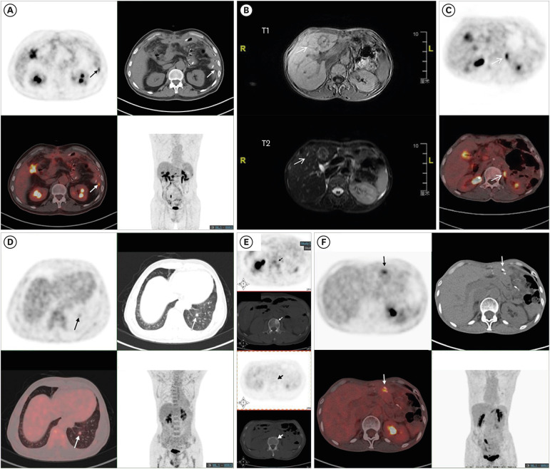 Tumor Location Causes Different Recurrence Patterns in Remnant Gastric Cancer.