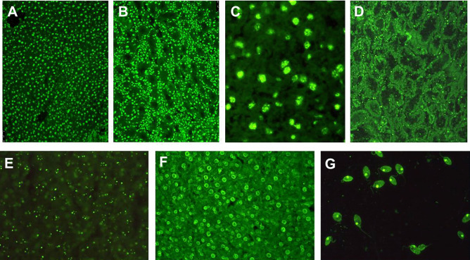 Autoimmune Hepatitis: Serum Autoantibodies in Clinical Practice.