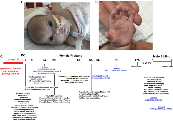 Autosomal recessive LRP1-related syndrome featuring cardiopulmonary dysfunction, bone dysmorphology, and corneal clouding.