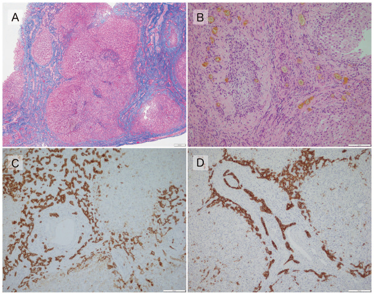 Relationships Between Histopathological Findings in the Liver and Prognosis in Patients With Biliary Atresia.