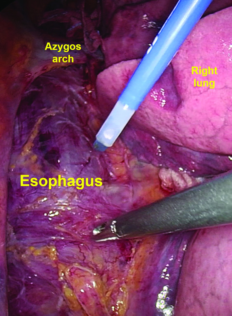 Esophageal Cancer Surgery in Dialyzed Patients: A Single Institution Case Series.