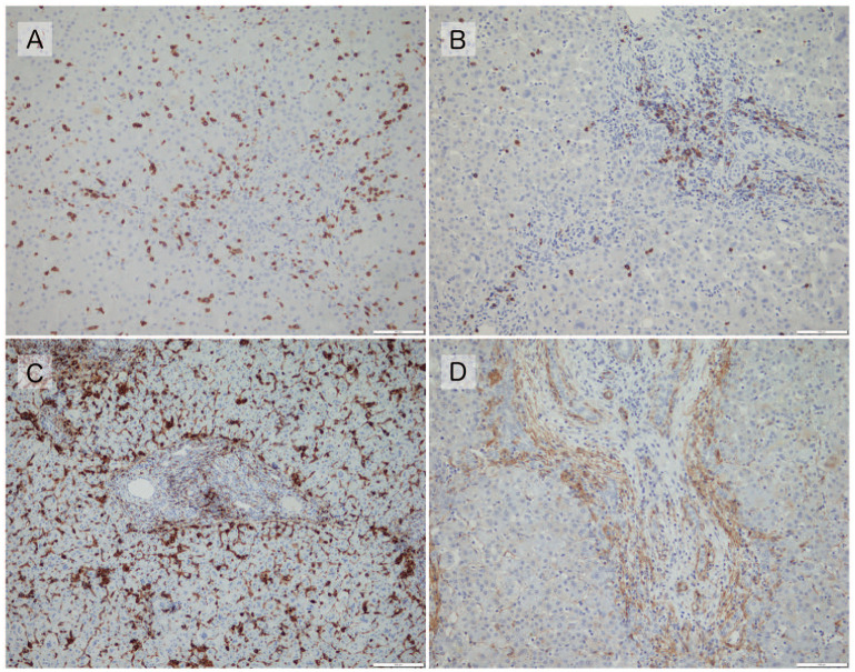 Relationships Between Histopathological Findings in the Liver and Prognosis in Patients With Biliary Atresia.