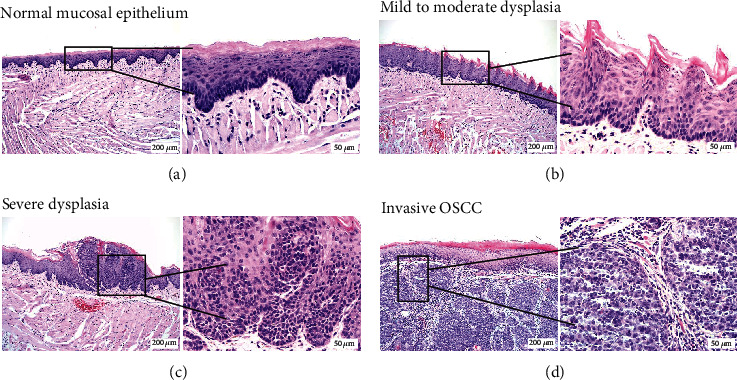 Chemoprevention of 4NQO-Induced Mouse Tongue Carcinogenesis by AKT Inhibitor through the MMP-9/RhoC Signaling Pathway and Autophagy.