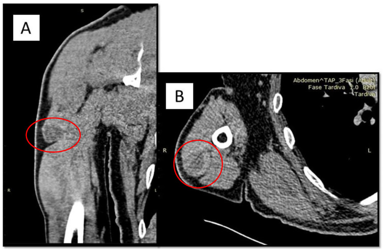 Angiomatoid Fibrous Histiocytoma (AFH) of the Right Arm: An Exceptional Case with Pulmonary Metastasis and Confirmatory EWSR1::CREB1 Translocation.