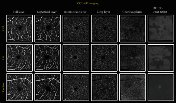 Multimodal Imaging and Macular Hyalocyte Count in a Patient with Acute Macular Neuroretinopathy.