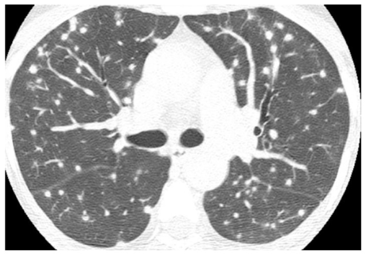 Chest Imaging in Systemic Endemic Mycoses.