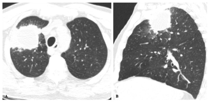 Chest Imaging in Systemic Endemic Mycoses.