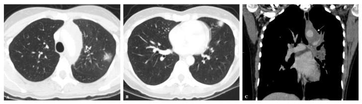 Chest Imaging in Systemic Endemic Mycoses.
