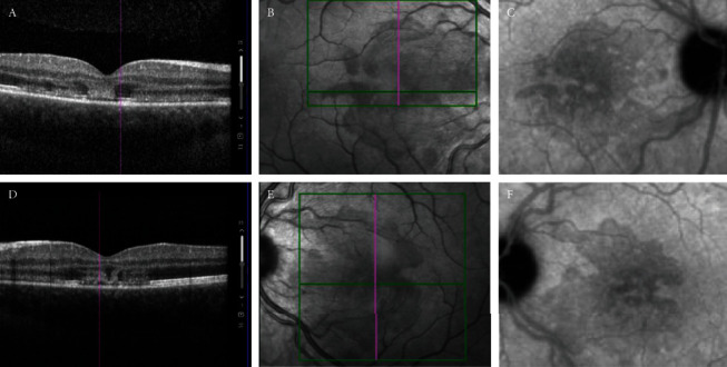 Multimodal Imaging and Macular Hyalocyte Count in a Patient with Acute Macular Neuroretinopathy.