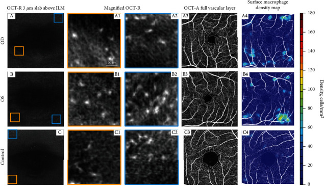Multimodal Imaging and Macular Hyalocyte Count in a Patient with Acute Macular Neuroretinopathy.