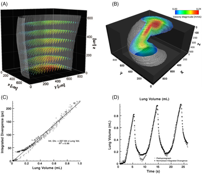 Innovations in thoracic imaging: CT, radiomics, AI and x-ray velocimetry.