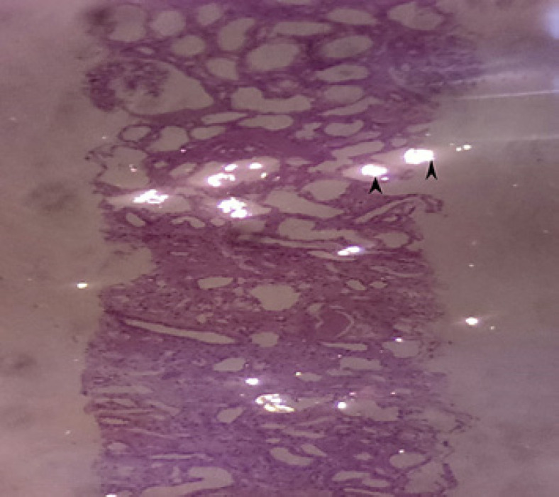 A Friend or a Foe? Bariatric Surgery in Chronic Kidney Disease: A Case Report.