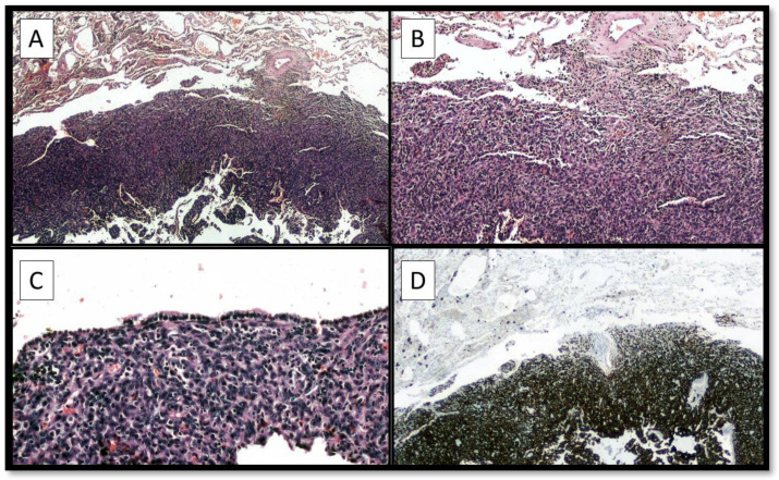 Angiomatoid Fibrous Histiocytoma (AFH) of the Right Arm: An Exceptional Case with Pulmonary Metastasis and Confirmatory EWSR1::CREB1 Translocation.