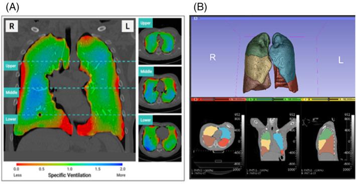 Innovations in thoracic imaging: CT, radiomics, AI and x-ray velocimetry.