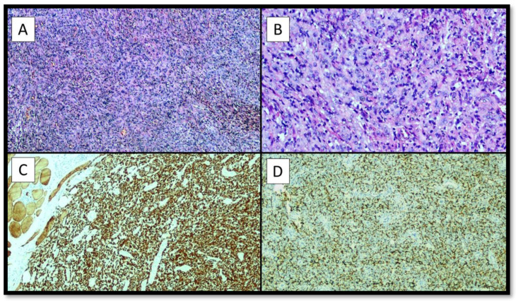 Angiomatoid Fibrous Histiocytoma (AFH) of the Right Arm: An Exceptional Case with Pulmonary Metastasis and Confirmatory EWSR1::CREB1 Translocation.