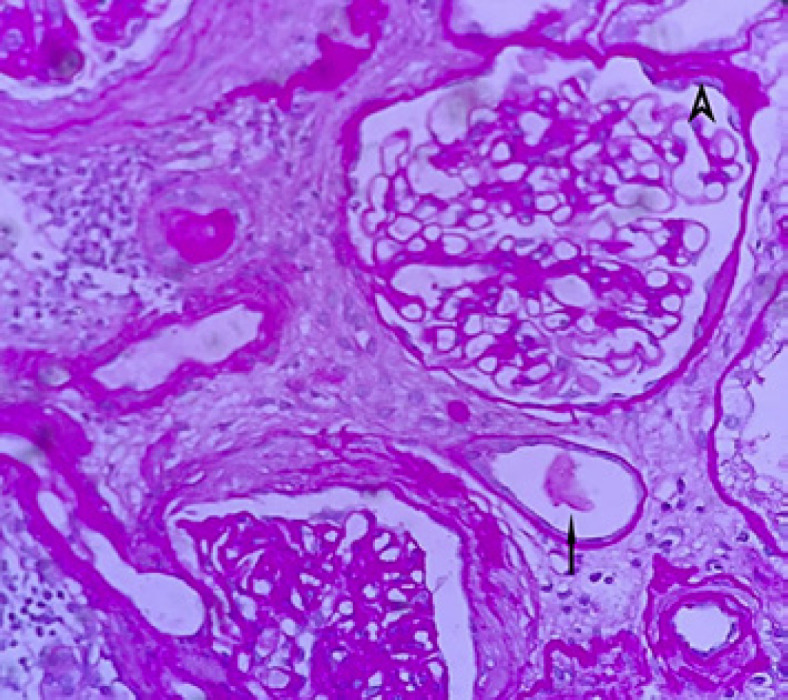 A Friend or a Foe? Bariatric Surgery in Chronic Kidney Disease: A Case Report.