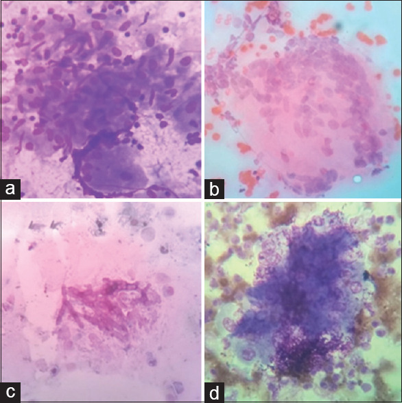 Accuracy of Bronchial Cytological Diagnosis in Lung Lesions in Comparison with Histopathology.