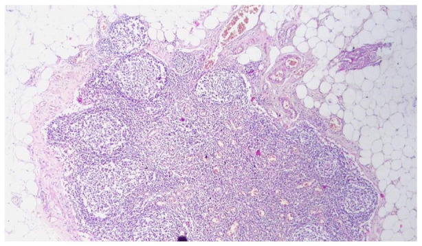 Lymph Nodes With Germinal Centers Are Not Associated With Tumor Response After Neoadjuvant Treatment in Locally Advanced Rectal Cancer.