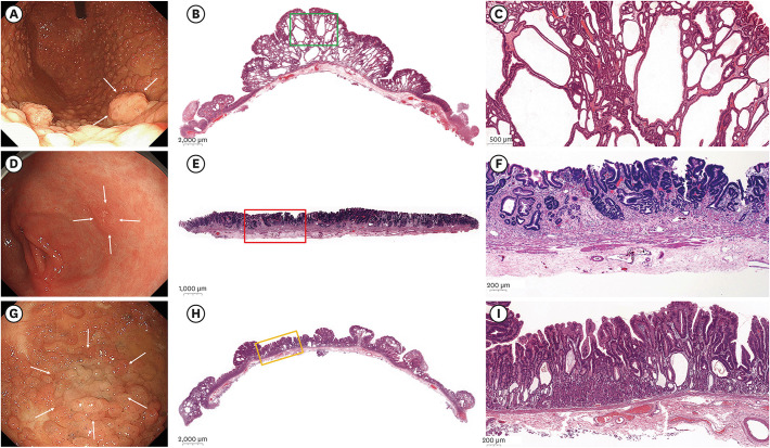 Endoscopic Findings and Treatment of Gastric Neoplasms in Familial Adenomatous Polyposis.