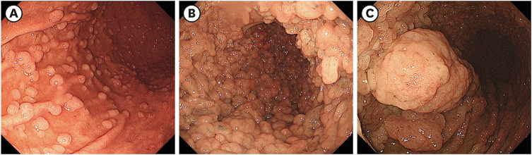 Endoscopic Findings and Treatment of Gastric Neoplasms in Familial Adenomatous Polyposis.