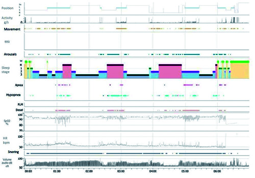 Resolution of daytime and night-time respiratory symptoms but persistent sleep apnea in severe asthma with the add-on of benralizumab.