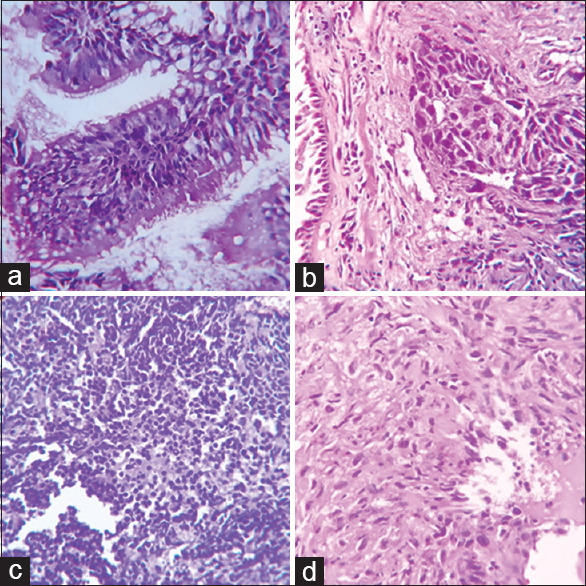 Accuracy of Bronchial Cytological Diagnosis in Lung Lesions in Comparison with Histopathology.