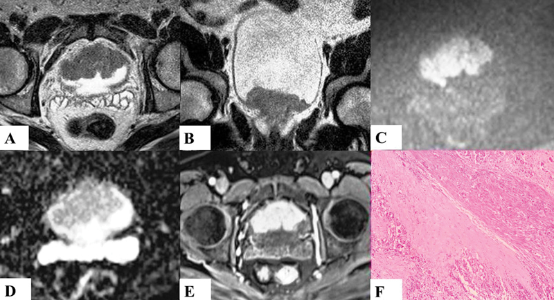 Application of Vesical Imaging-Reporting and Data System in Evaluation of Urinary Bladder Cancer Using Multiparametric Magnetic Resonance Imaging: A Hospital-Based Cross-Sectional Study.