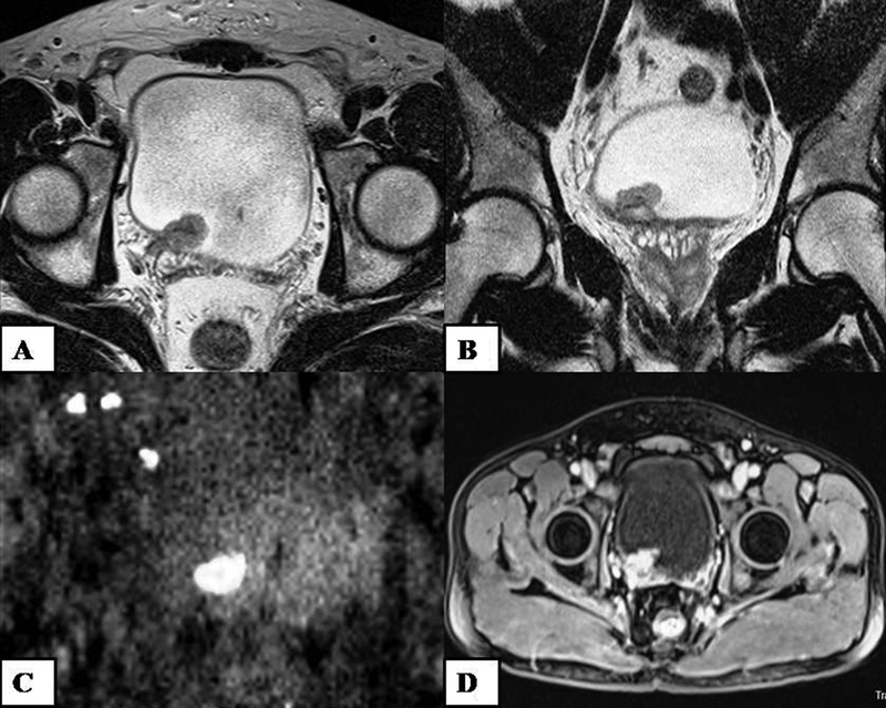 Application of Vesical Imaging-Reporting and Data System in Evaluation of Urinary Bladder Cancer Using Multiparametric Magnetic Resonance Imaging: A Hospital-Based Cross-Sectional Study.