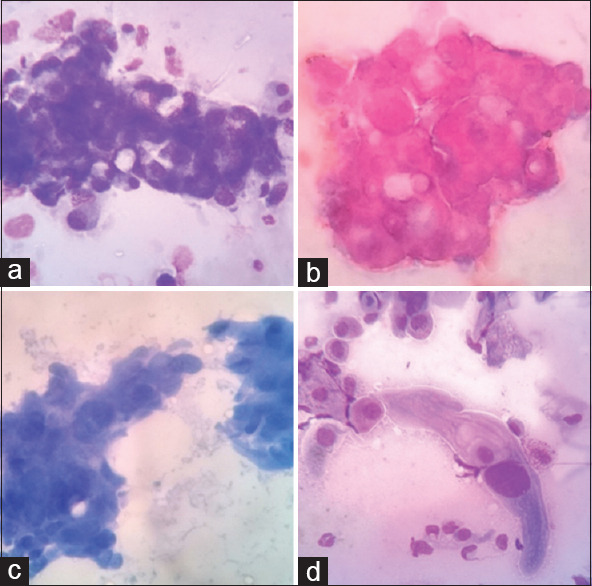 Accuracy of Bronchial Cytological Diagnosis in Lung Lesions in Comparison with Histopathology.